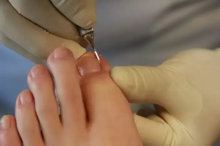 fungal infection during pedicure