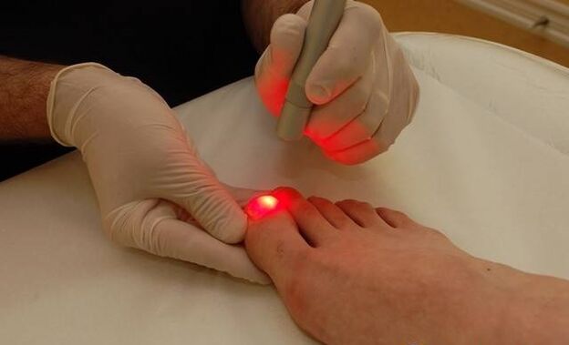 laser treatment of toenail fungus