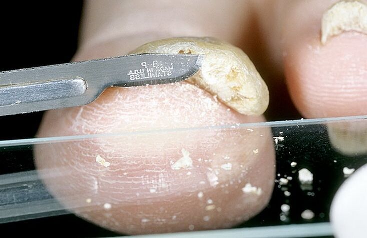 nail scraping to diagnose fungus