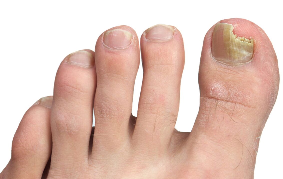 photo of toenail fungus