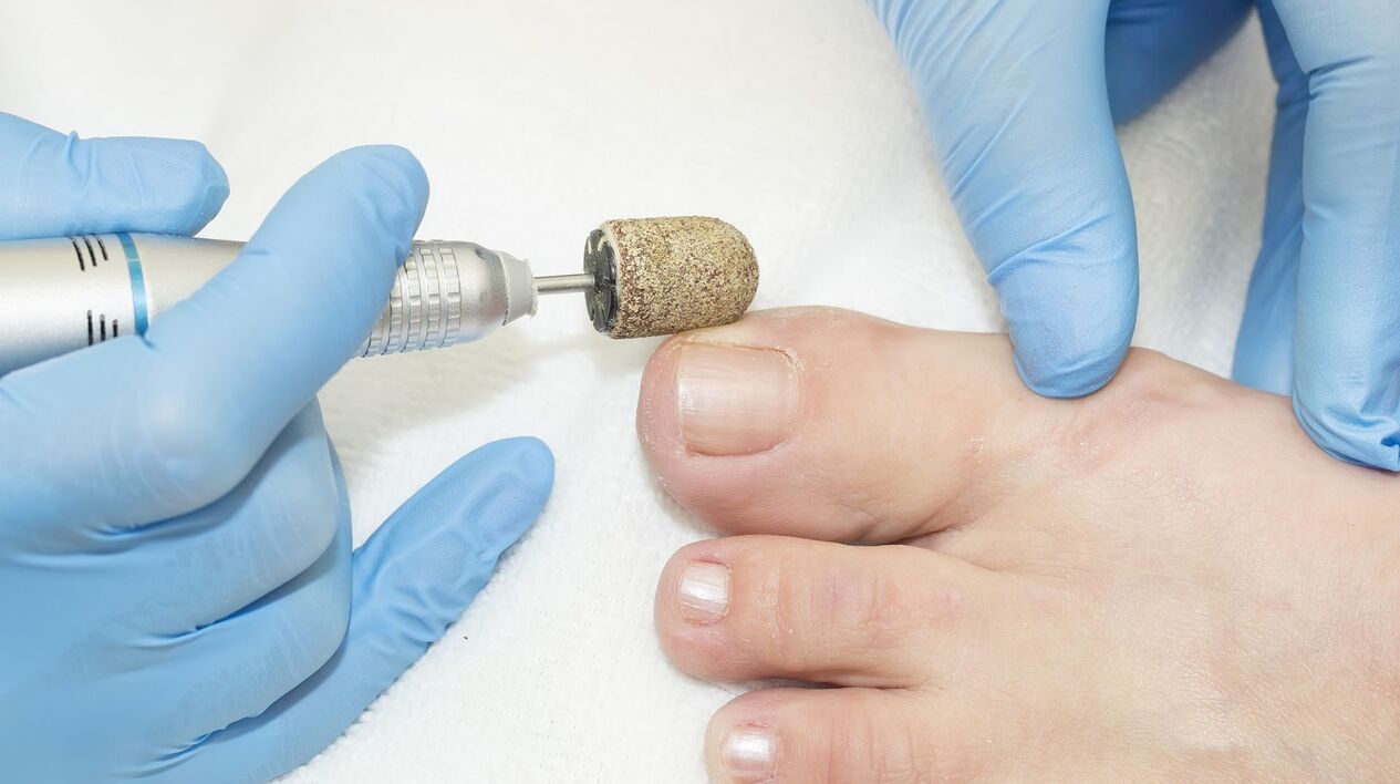 hardware treatment of toenail fungus