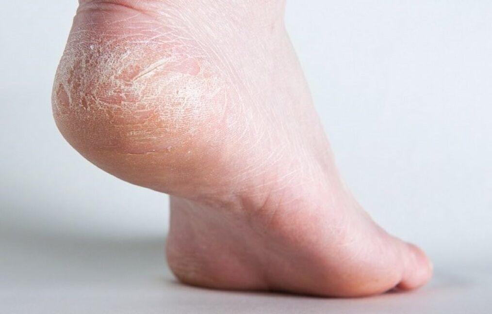skin fungus on the feet how to treat