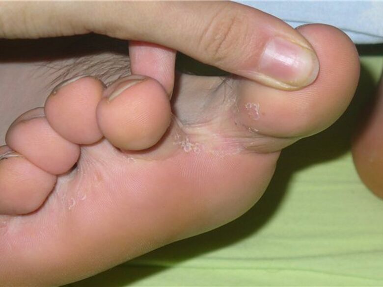 symptoms of fungus on the toes