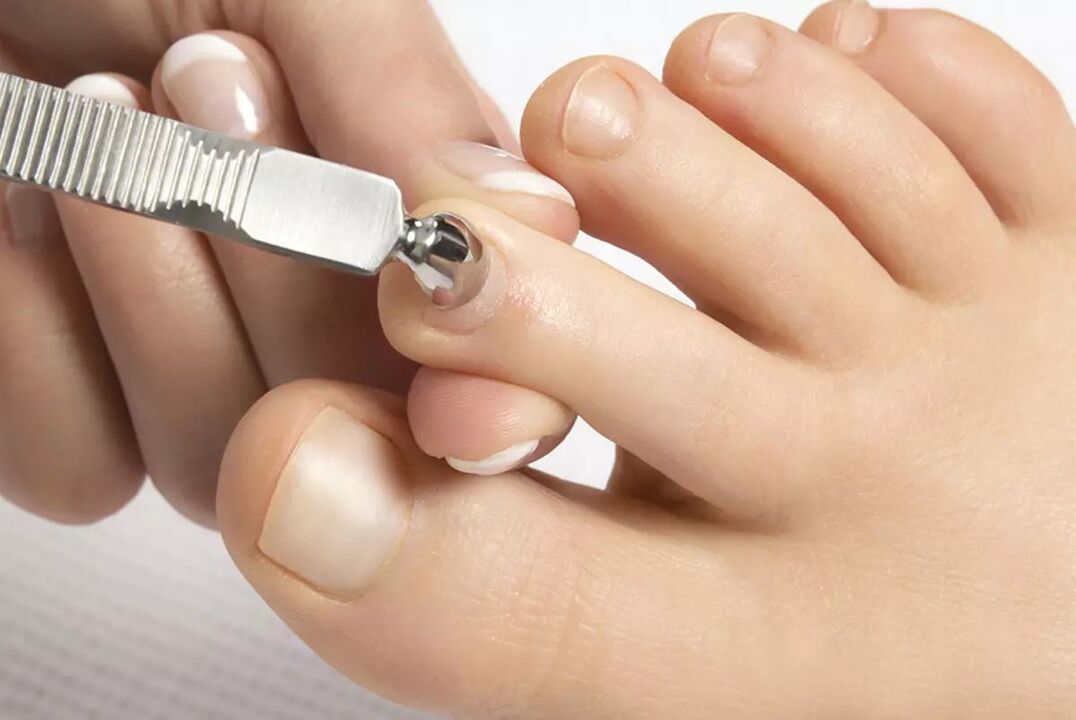 what to use for nail fungus