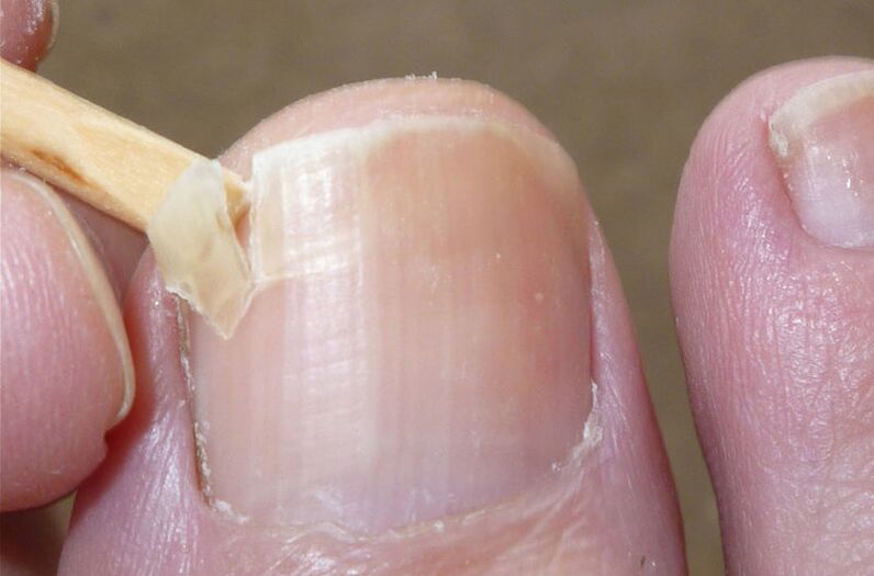 Damaged nails are a risk factor for fungal infections