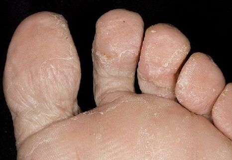 Home Phase of fungi, between the fingers
