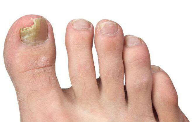 Fungi on the thumb foot