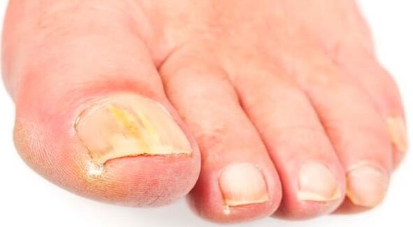 Fungus nail