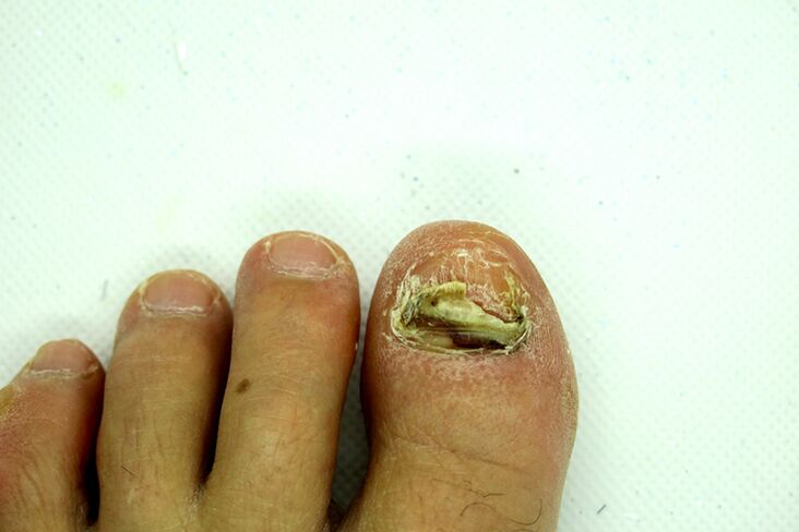 Finger Fungeus - Heavy Phase