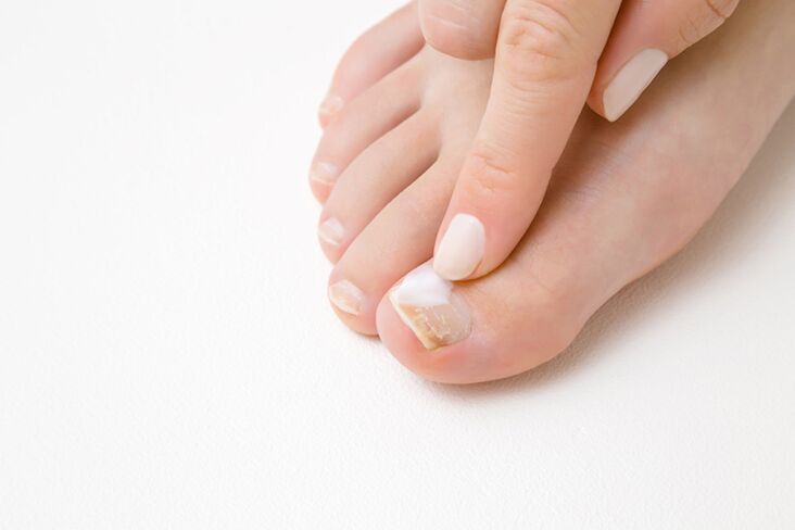 Finger treatment in fat from mushrooms