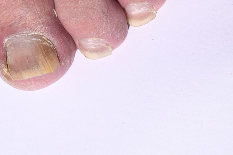 Home phase of mycosis nails on your feet