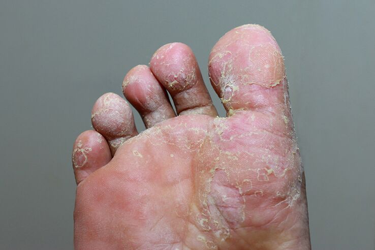 Strong phase of mycosage of finger skin