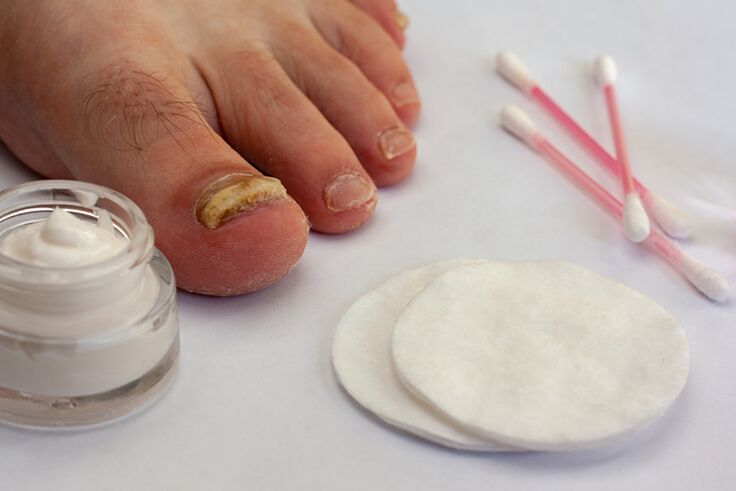 Treatment of finger fungus with fungus cream