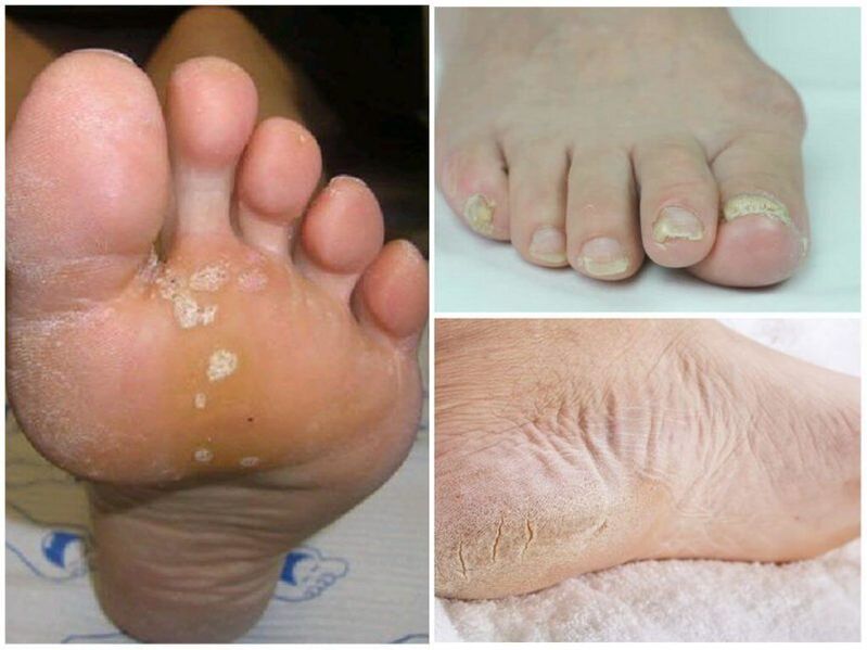 Symptoms of mycosis