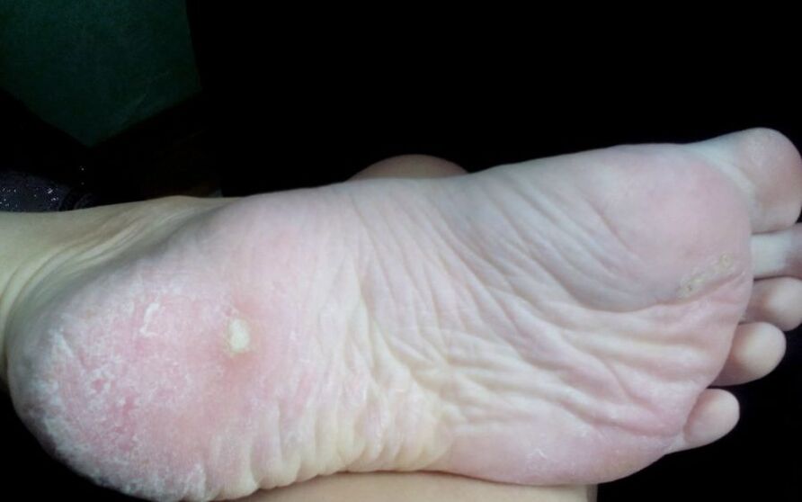 What does the fungus look like and manifest alone