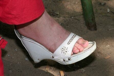 dry skin on your feet