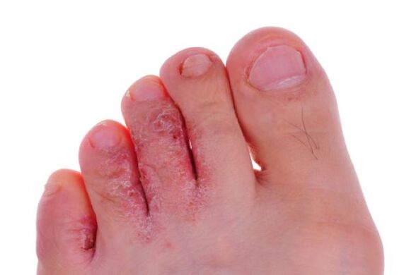 fungal diseases of the fingers