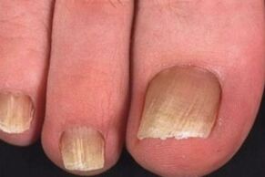 fungal toenail infection