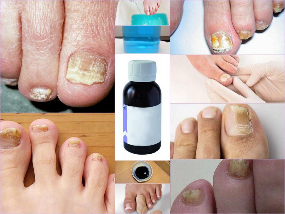 remedies for toenail fungus