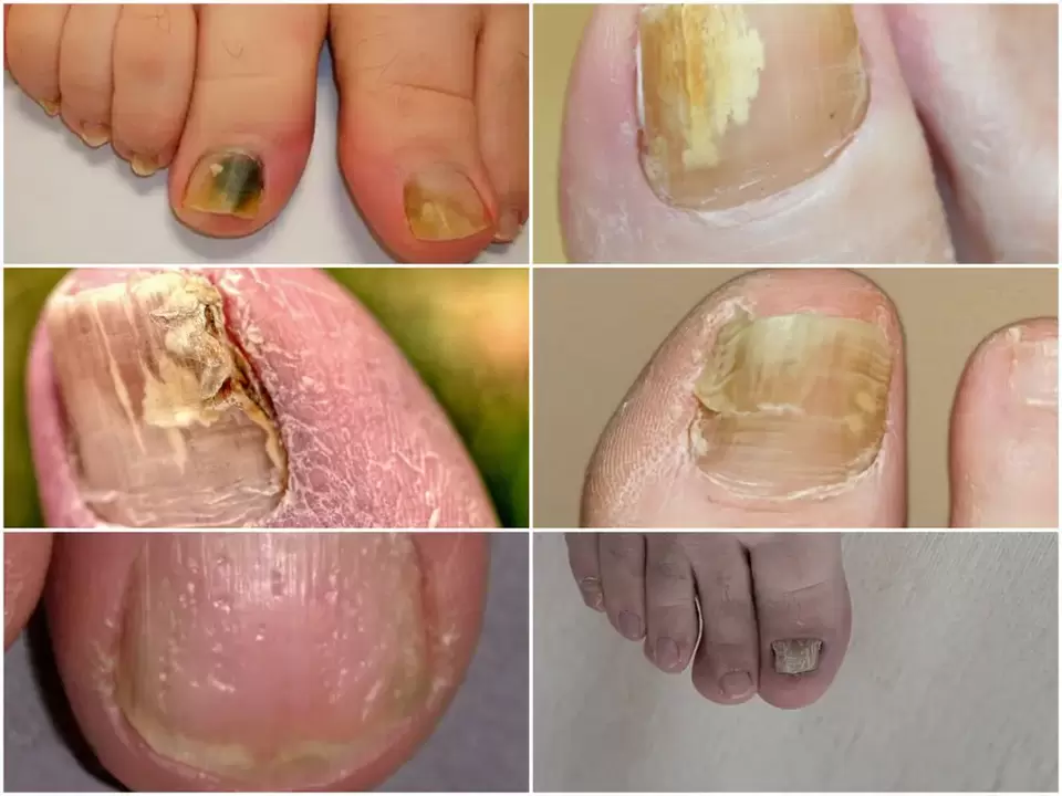 Symptoms of onychomycosis - changes in the color and structure of the nails