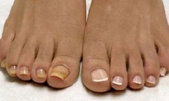 Healthy and fungal nails