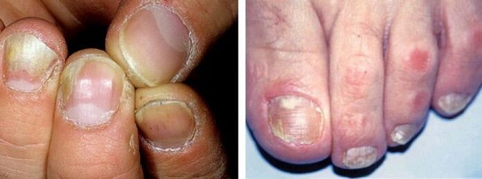 manifestations of fungal infection on the nails