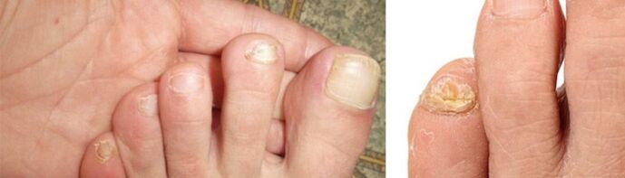 photo manifestation of fungus on toenails