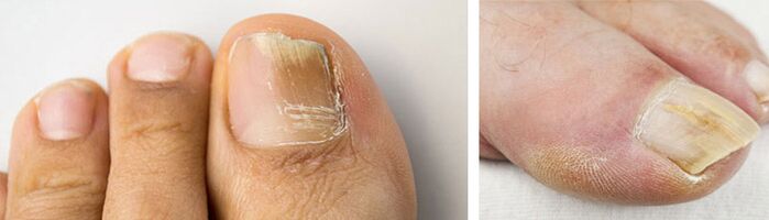 a photograph of a fungal infection on the nail of the big toe