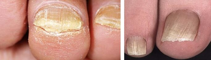nail damage by fungal infection