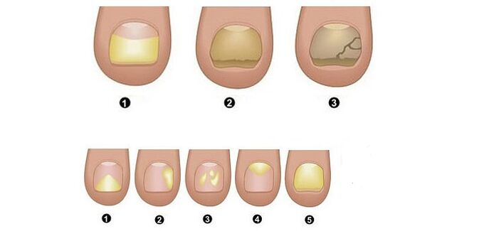 stages and symptoms of nail fungus