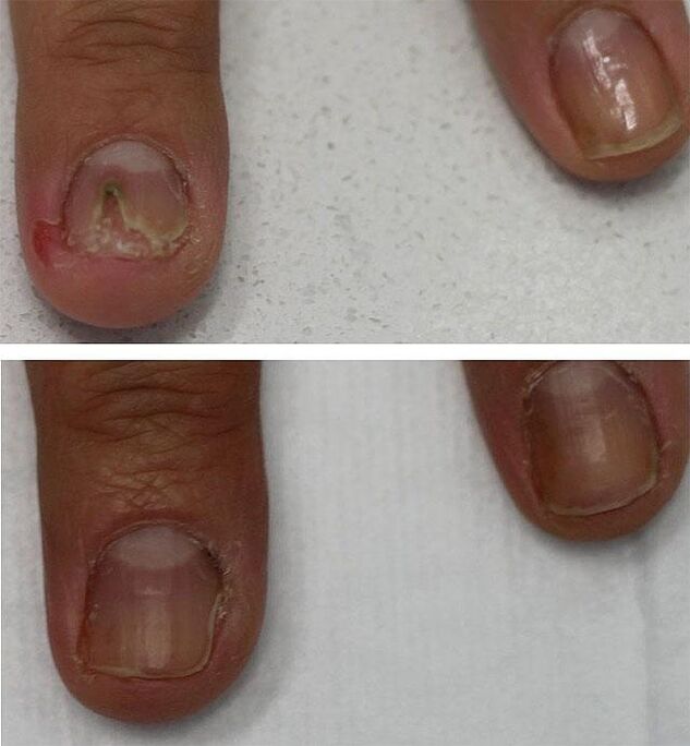 fungal infection of the toenails