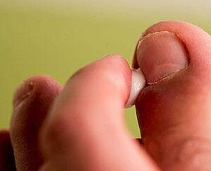 fungus on the nail nails