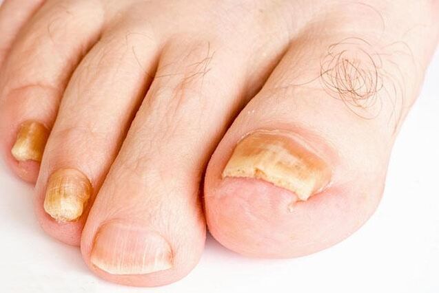 what a fungus looks like on toenails