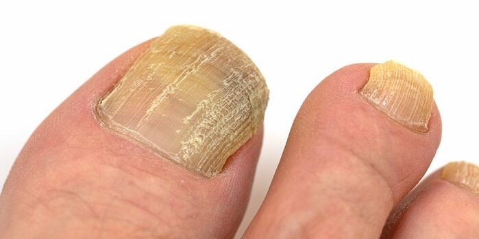 nail damage with advanced fungal infection