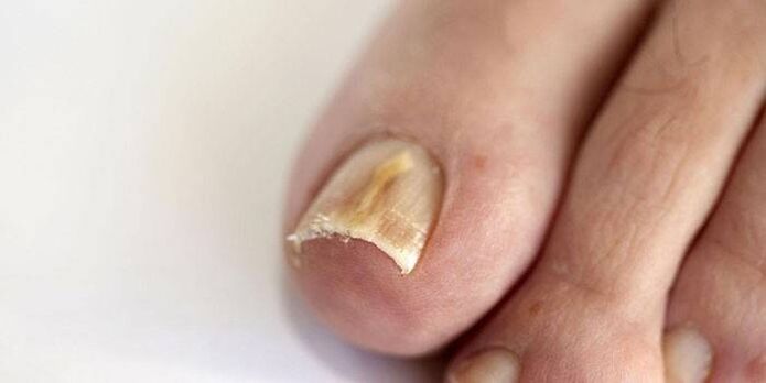 fungus on the nail nails