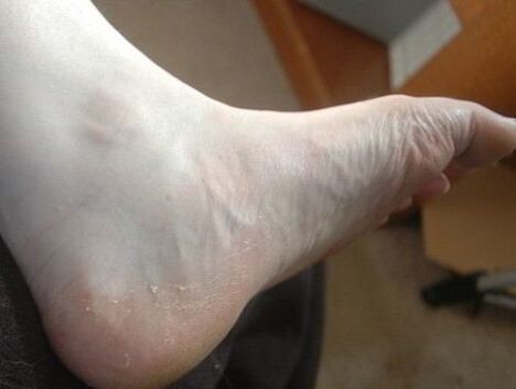 peeling of the feet on the foot as a sign of a fungal infection