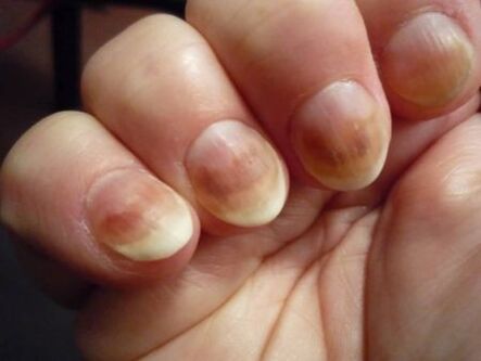 fungus on the nails