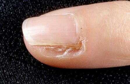 removal of part of the nail by fungus