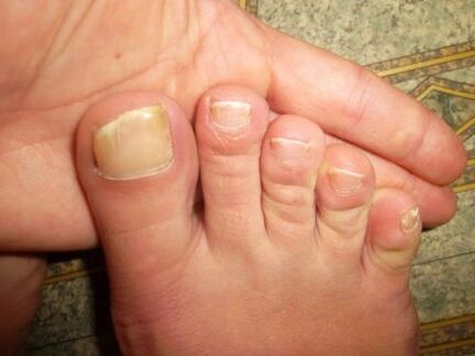 toenails affected by fungus